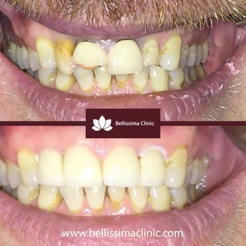 Dental Crowns Before and After 2