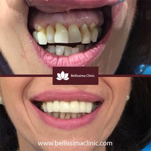 Dental Crowns Before and After 1