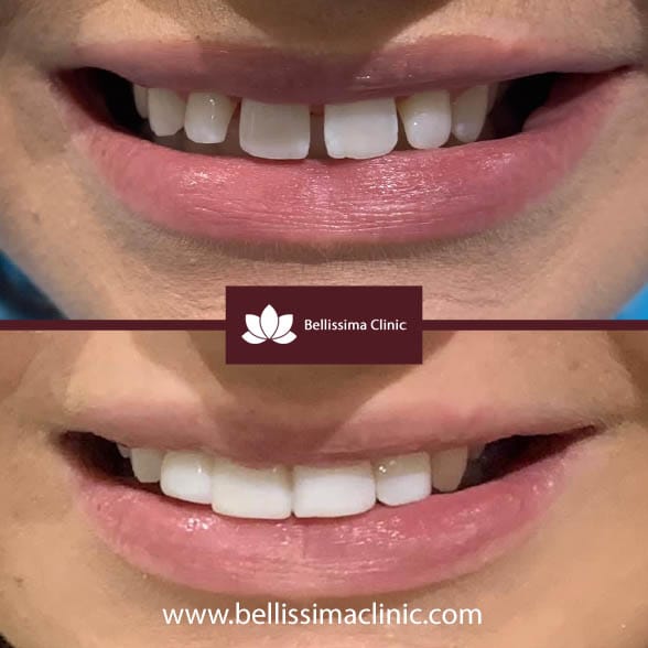 Cosmetic dentist before & after Solihull