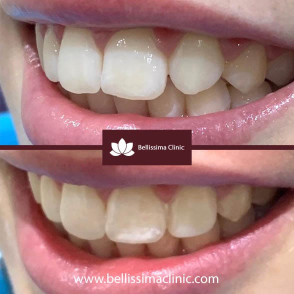 Composite Veneers Before & After 4
