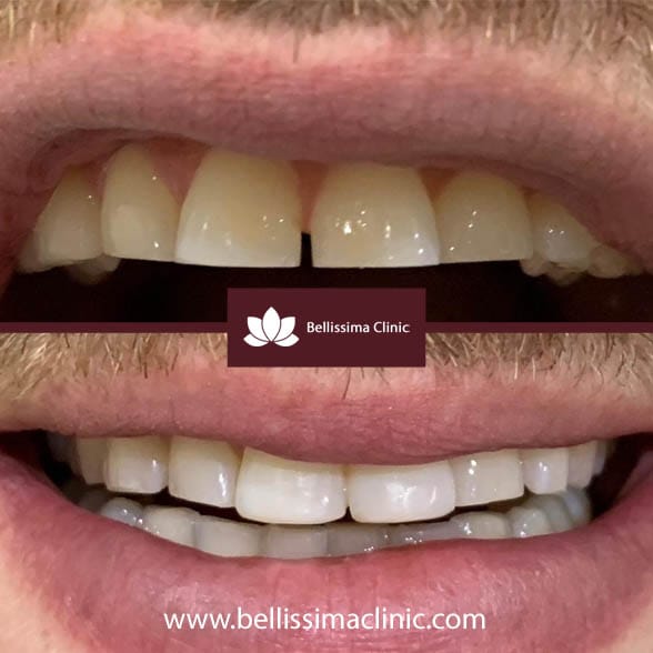 Composite Veneers Before & After 5
