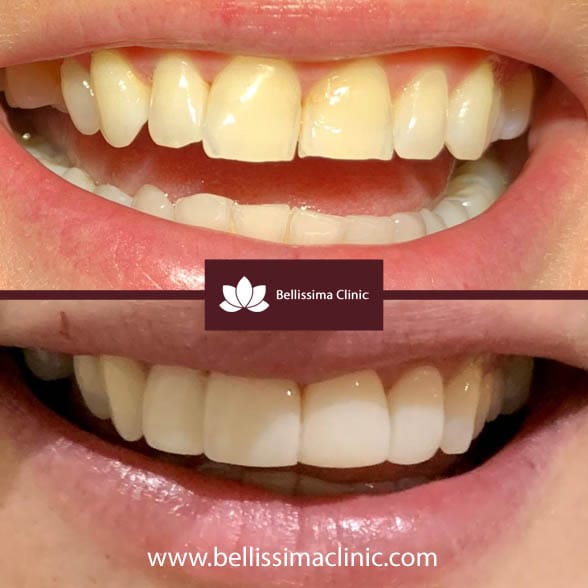 Composite Veneers Before & After 6