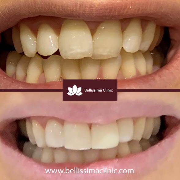 Composite Veneers Before & After 7
