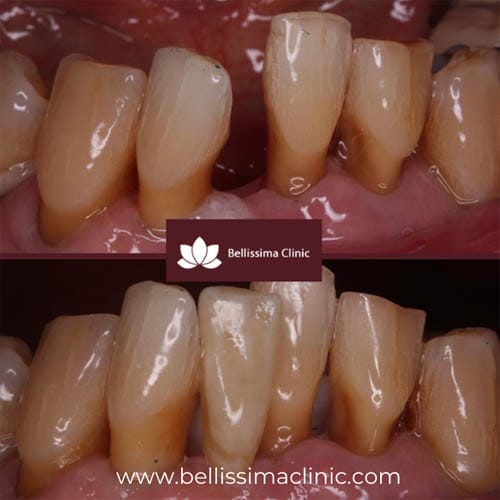 Denture before and after 2 solihull