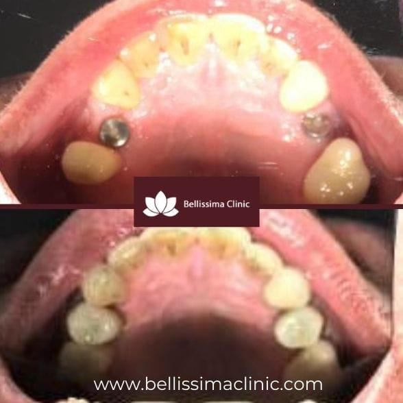 Dental Implants Before And After 2