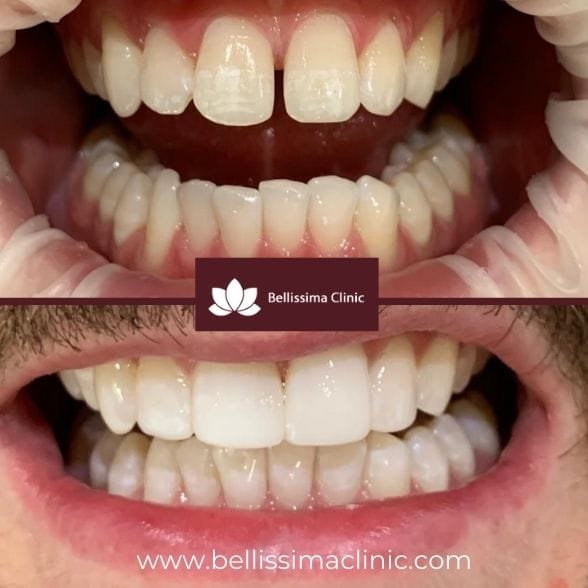 Mini Smile Make Over Before & After 1 Solihull